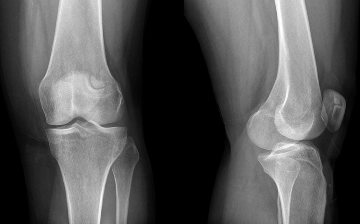 L'arthrose du genou sur les rayons X avant d'utiliser Hondroine