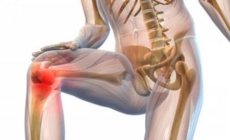 Arthrose de l'articulation du genou