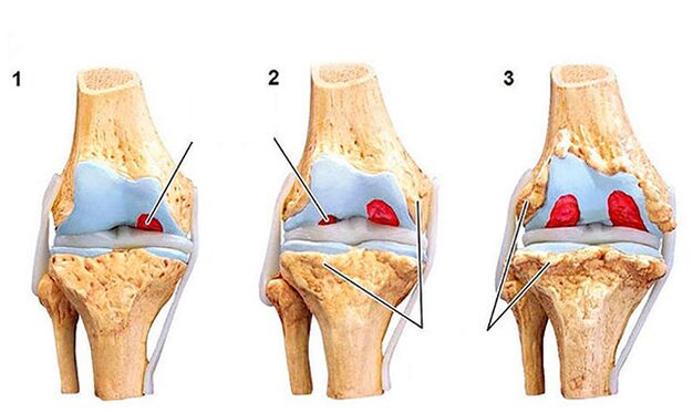 Le degré de développement de l'arthrose