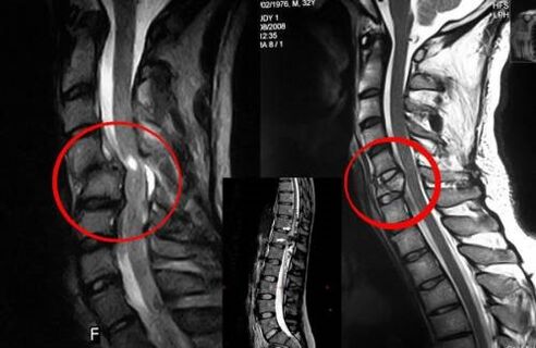 Compression de la moelle épinière – une indication chirurgicale